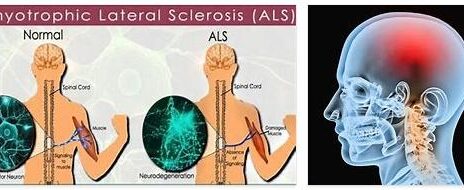 Amyotrophic Lateral Sclerosis