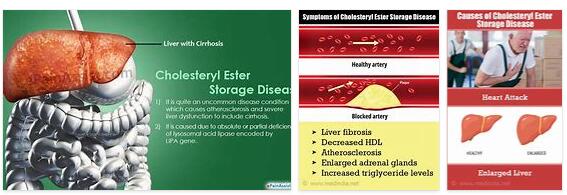 Cholesterol ester storage disease