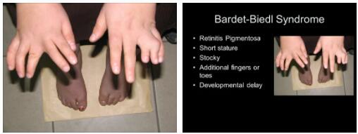 Bardet -Biedl Syndrome